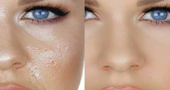 خواص برگ بو برای پوست ؛ گیاه برگ بو از بروز چین و چروک جلوگیری می کند