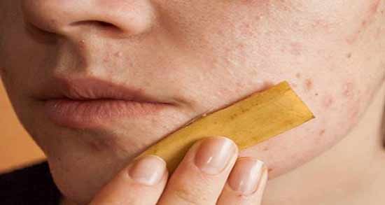 خواص موز برای پوست ؛ خاصیت عالی و سازگاری بالای موز با پوست