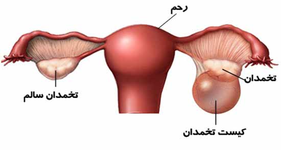 رازیانه برای کیست تخمدان ؛ داروی گیاهی موثر برای از بین بردن کیست تخمدان