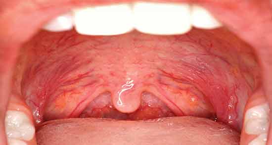 التهاب حنجره ؛ علائم و نشانه های التهاب حنجره چیست