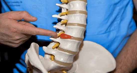 التهاب دیسک کمر ؛ برای درمان التهاب دیسک کمر چه روشی مناسب است