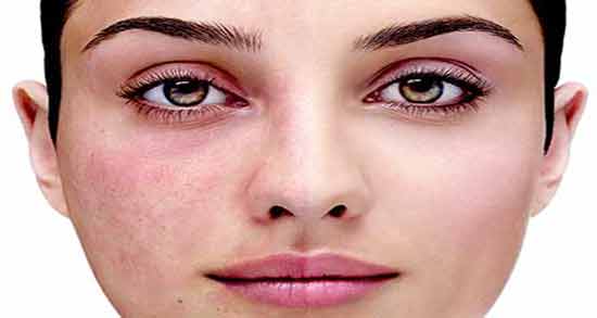 التهاب صورت ؛ ماسک ضد التهاب صورت با طب سنتی و درمان بعد از اصلاح
