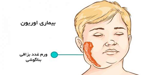 اوریون ؛ معرفی بیماری عفونی دوران کودکی به نام اوریون