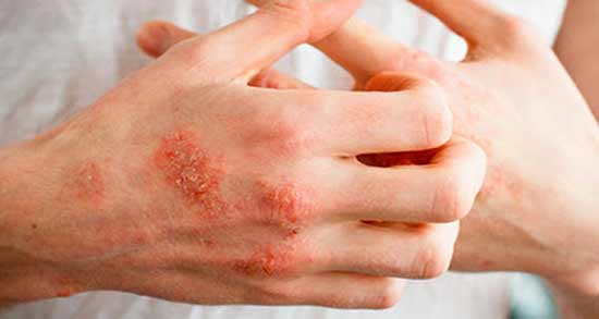 اگزما ؛ علائم و روش درمان اگزما و ناراحتی پوستی