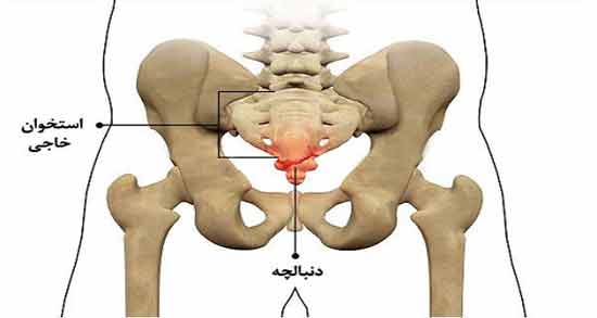 درد استخوان دنبالچه ؛ پماد و ورزش برای درد دنبالچه و درمان در طب سنتی