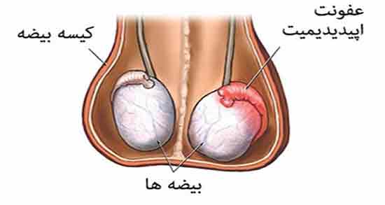 درد بیضه سمت راست ؛ چه عواملی باعث ایجاد درد بیضه سمت راست می شود