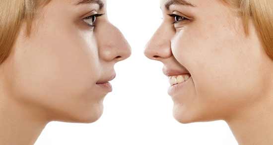 عوارض جراحی زیبایی بینی ؛ ایجاد مشکلات تنفسی با عمل زیبایی بینی