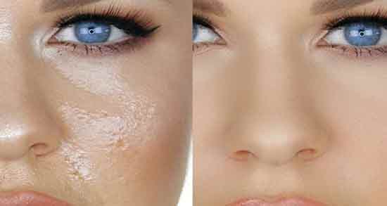 پوست چرب ؛ از کجا بفهمیم پوست صورتمان چرب است یا خشک