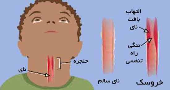 خواص اب لپه برای خروسک ؛ تاثیر خوردن اب لپه برای درمان درمان خروسک کودکان