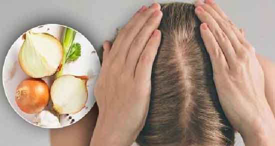 آب پیاز برای ریزش مو ؛ فواید استفاده از آب پیاز برای درمان ریزش مو