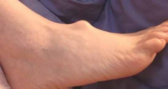 تعبیر خواب غده در پا ، معنی غده در پا در خواب های ما چیست
