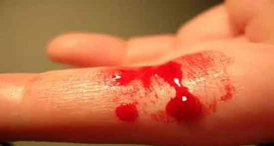 تعبیر خواب لخته خون از بدن ، معنی لخته خون از بدن در خواب های ما چیست