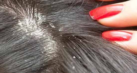 تعبیر خواب شپش سر زن معنی شپش سر زن در خواب های ما چیست